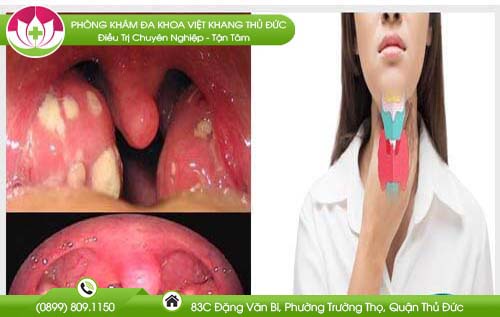 Vòm họng có đốm trắng là bị gì? Tư vấn Online