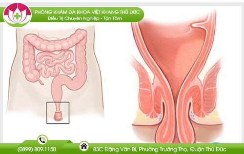 Xử trí khi trẻ bị sa trực tràng
