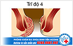 Bệnh trĩ cấp độ 4