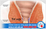 Búi trĩ nhỏ có cần chữa không, có nguy hiểm không?