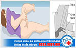 Cách đẩy búi trĩ vào trong đúng cách