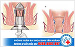 Cách trị bệnh trĩ hiệu quả nhất hiện nay là gì?