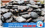 Chữa bệnh trĩ bằng hạt gấc - Tin vui cho bệnh nhân mắc bệnh trĩ
