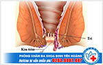 Chữa trĩ bằng phương pháp tiêm xơ búi trĩ