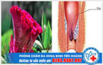 Công dụng của cây mào gà với bệnh trĩ