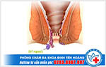 Dấu hiệu ban đầu của bệnh trĩ ngoại - Nhận biết sớm chữa kịp thời