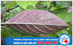 Dùng lá mơ chữa bệnh trĩ có được không?