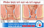 Sự khác nhau giữa trĩ nội và trĩ ngoại