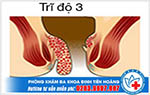 Trĩ độ 3 có cần phẫu thuật không?